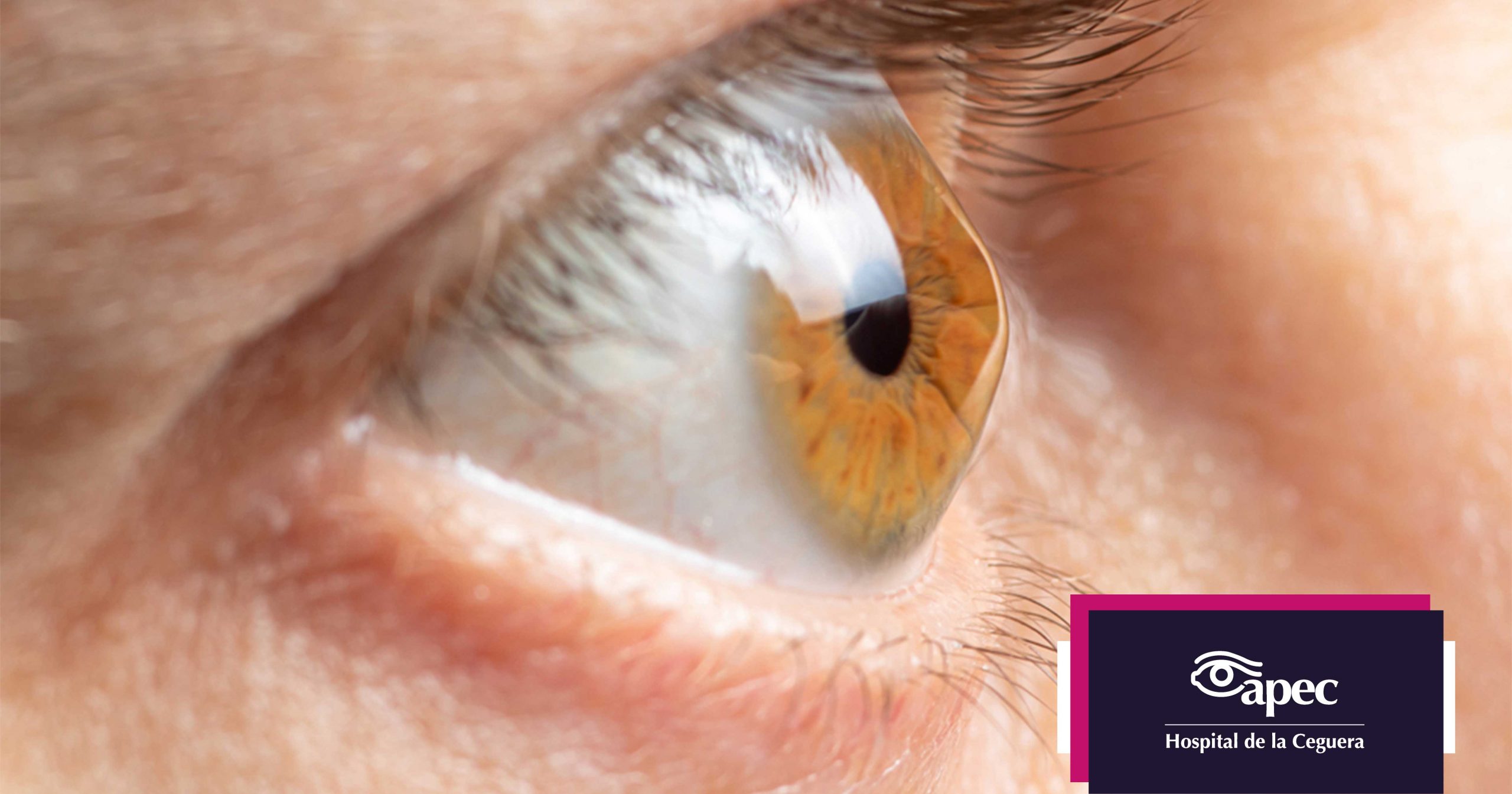 cornea-apec-hospital-ceguera-edomex-cdmx-reticulacion-colageno-corneal-cross-linking-queratocono