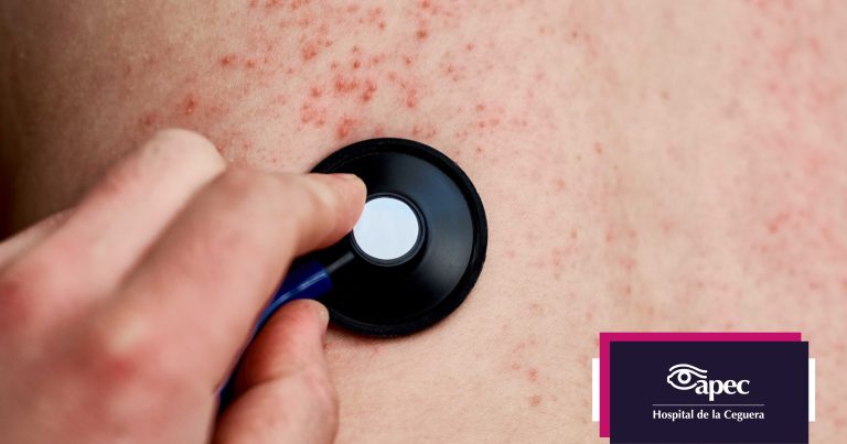 sarampion-cornea-complicaciones-vista-ojos-apec