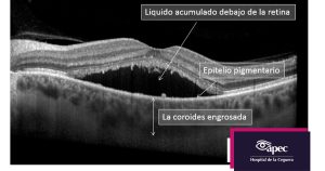 hospital-apec-ceguera-coyoacan-cdmx-retina-coriorretinopatía-serosa-central