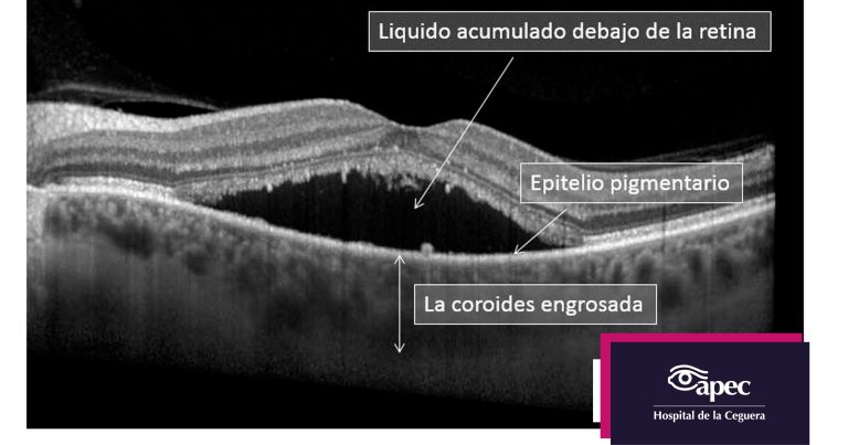 hospital-apec-ceguera-coyoacan-cdmx-retina-coriorretinopatía-serosa-central